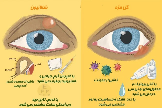آموزش درمان گل مژه