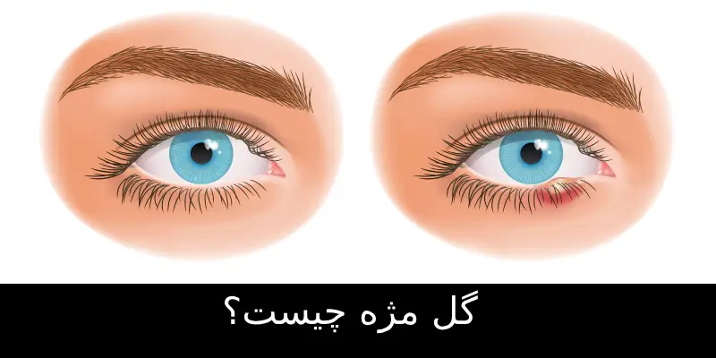 گل مژه چیست؟