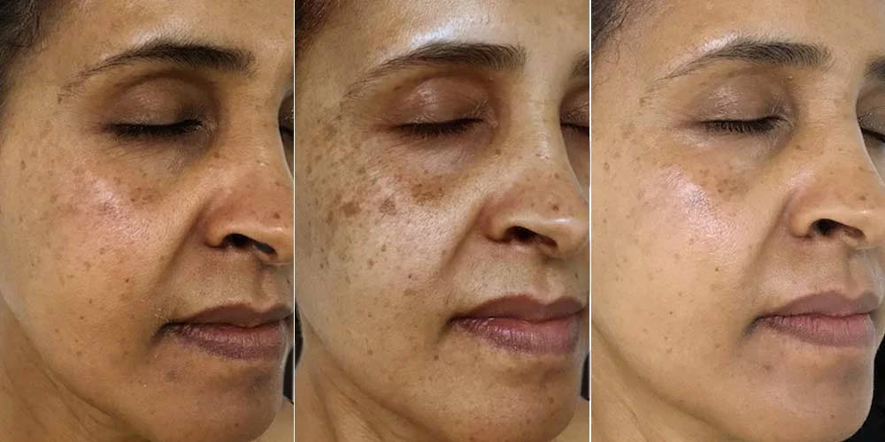 ترکیبات مؤثر سرم روشن کننده راکوتن