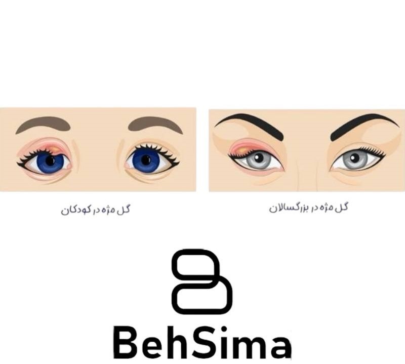 پیشگیری از گل مژه