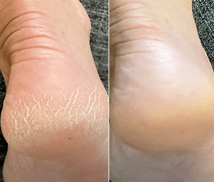 پیشگیری از ترک‌ های پوستی و پوسته‌ پوسته شدن